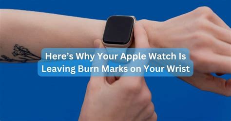 watch marks on wrist